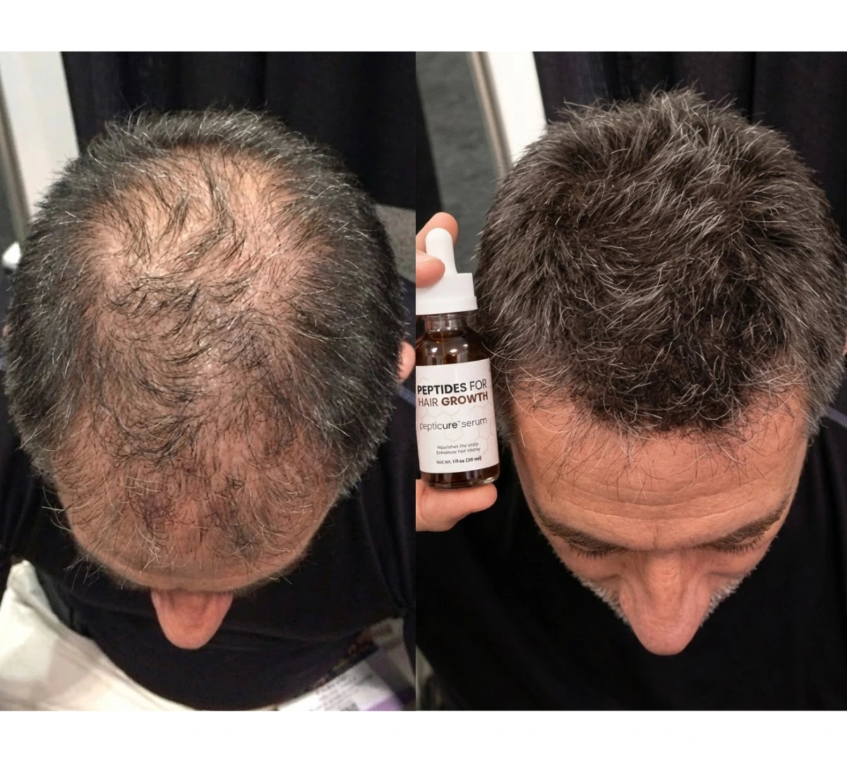 "I quit minoxidil after 3 years. Best decision I made."