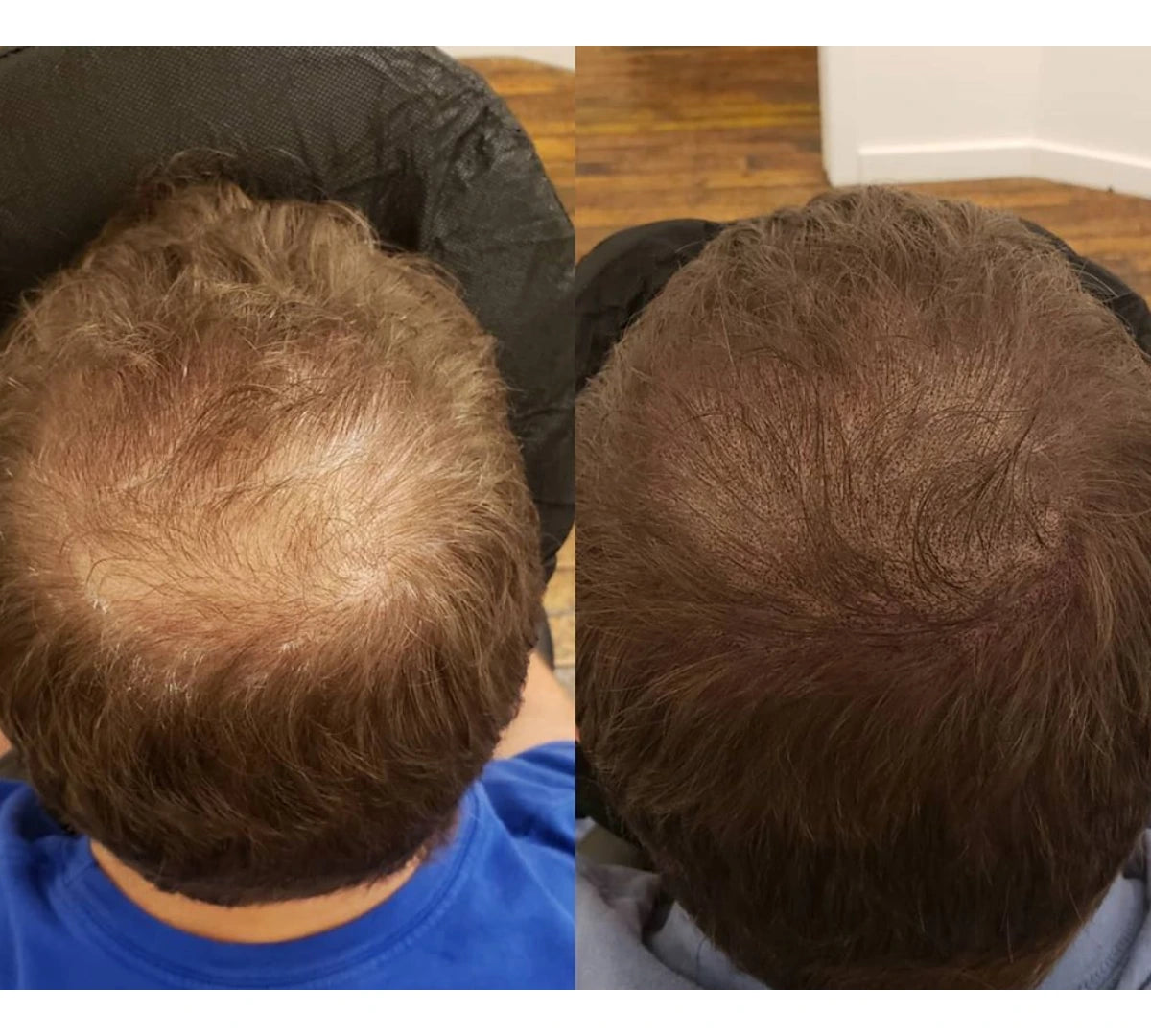 "I'm 27. Finasteride scared me. This didn't."